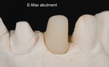 emax-abutment
